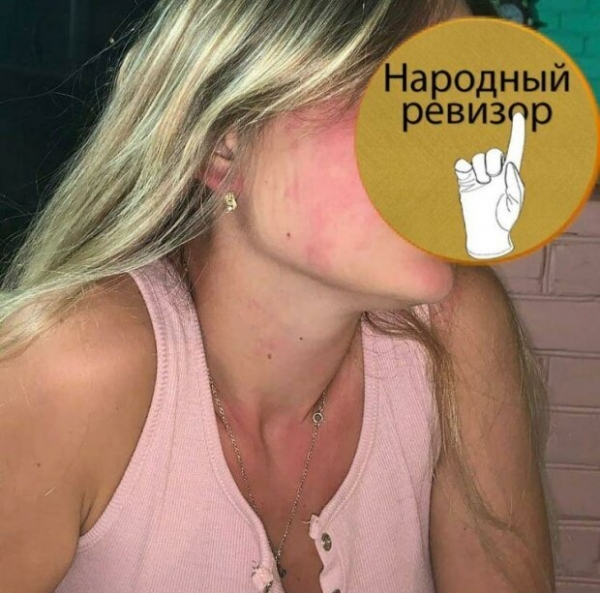 Курортное вино чуть не отправило украинку на больничную койку — "Пятна по всему телу" Курортное вино чуть не отправило украинку на больничную койку — "Пятна по всему телу"