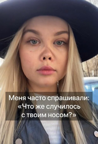 Начал крошиться изнутри: девушка лишилась носа из-за роковой случайности, но не расстроилась - теперь о ней знают все Начал крошиться изнутри: девушка лишилась носа из-за роковой случайности, но не расстроилась - теперь о ней знают все