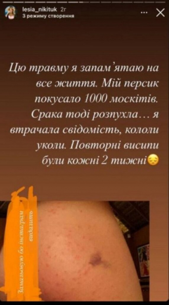 Леся Никитюк показала жуткие травмы, полученные на съемках Леся Никитюк показала жуткие травмы, полученные на съемках
