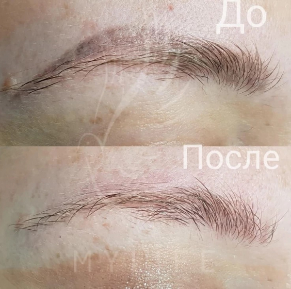 Удаление татуажа Удаление татуажа